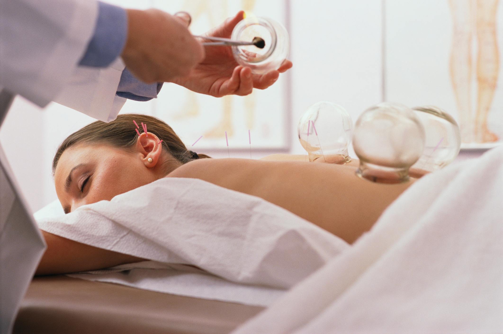 Relaxed-woman-getting-acupuncture-in-her-back-how-to-release-endorphins